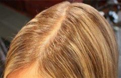 脱发让我的生活变得一团糟