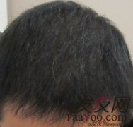 我为什么会脱发