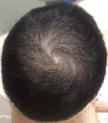 解决脱发最佳的方法