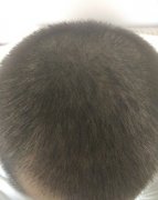 头发稀疏怎么办啊