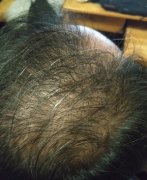 脱发之后的影响