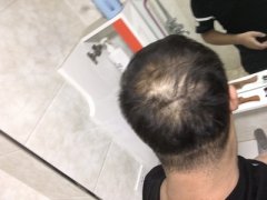 植发手术都解救不了我了