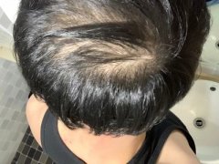 不伤害头发的脱发解决方法