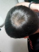 怎么才能改善稀疏头发