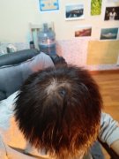 摆脱了脱发的痛苦