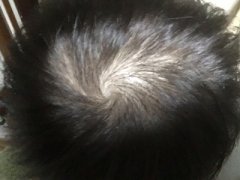 不用植发就能解决形象问题