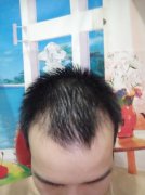 对抗脱发带来的伤害