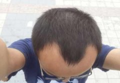 安徽发友的脱发经历