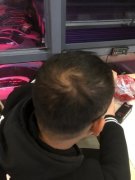 脱发到底该怎么治