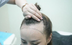 解决发际线高的问题