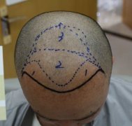 学生脱发应该怎么办