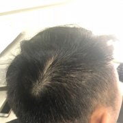 IT行业，十男九秃