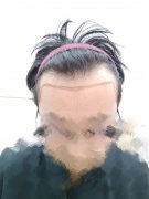 脱发为什么会加重