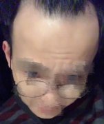 怎么才能让脱发不困扰生活