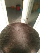 脱发让我很心碎