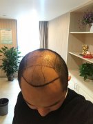头发脱落的太多了