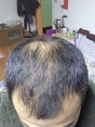 头发稀少需要什么样的解决方法