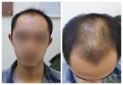 怎么解决头发稀少的问题