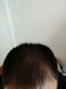 头发稀疏的苦恼