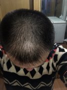 头发稀少应该怎么做