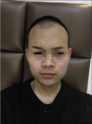 脱发的解决方法是什么
