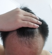 为什么会脱发
