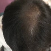 头发稀疏该怎么办