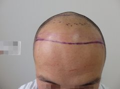 脑门高的问题怎么解决