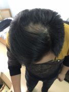 脱发造成的形象问题怎么解决