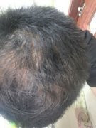 怎么拯救稀少的头发