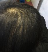 不重视头发造成的后果