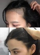解决疤痕导致的脱发