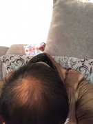 脱发不要病急乱投医