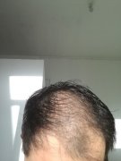 为什么头发会那么稀疏