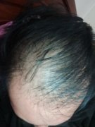 天生头发稀疏的问题