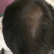 脱发是什么原因导致的