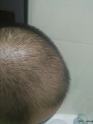 头发掉的太多怎么办