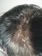 没想到我也会变成脱发的一员