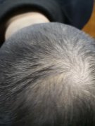 头发一直都在脱落怎么办