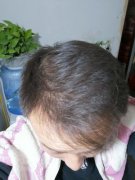 脱发来的太早了