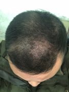 我的头发脱落了怎么办