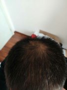 头发稀疏的可怜人啊