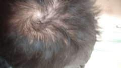 狂掉的头发简直是魔鬼