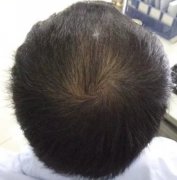 脱发是个拦路虎啊