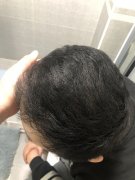 怎么解决烦人的脱发