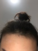 脱发对我的影响