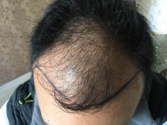 为什么我的头发脱落这么厉害