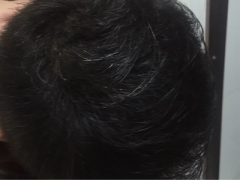 脱发到底是什么原因导致的