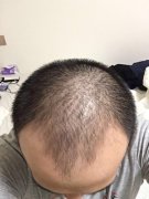 脱发带来的困扰只有它能解决