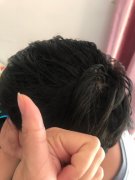 为什么要让我承受脱发的痛苦